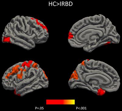 Cortical Gray Matter and Hippocampal Atrophy in Idiopathic Rapid Eye Movement Sleep Behavior Disorder
